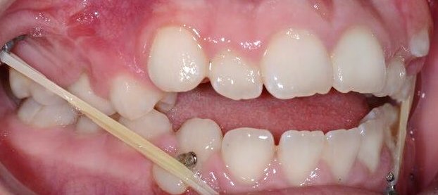 Bolardai-ortodontinis gydymas