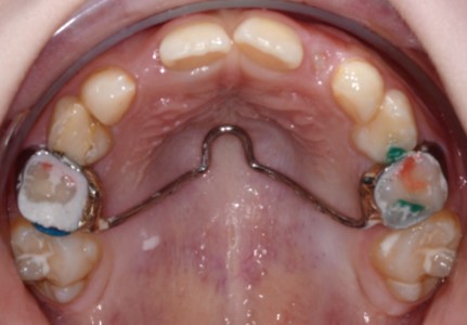 Vaikų-ortodontinis-gydymas