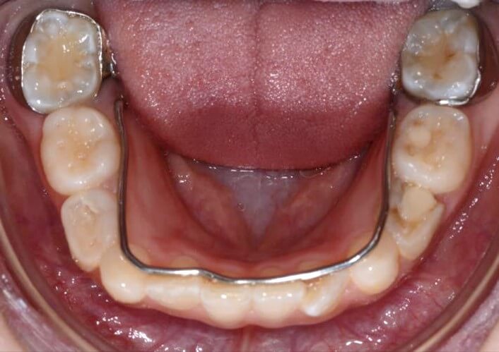 Vaikų dantu gydymas